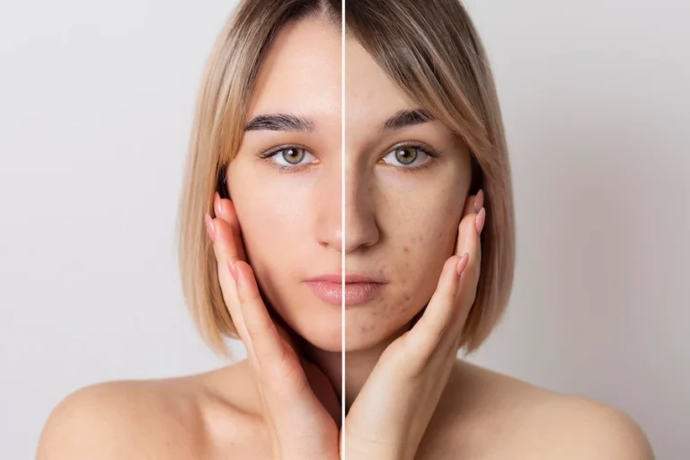 leke giderici serum